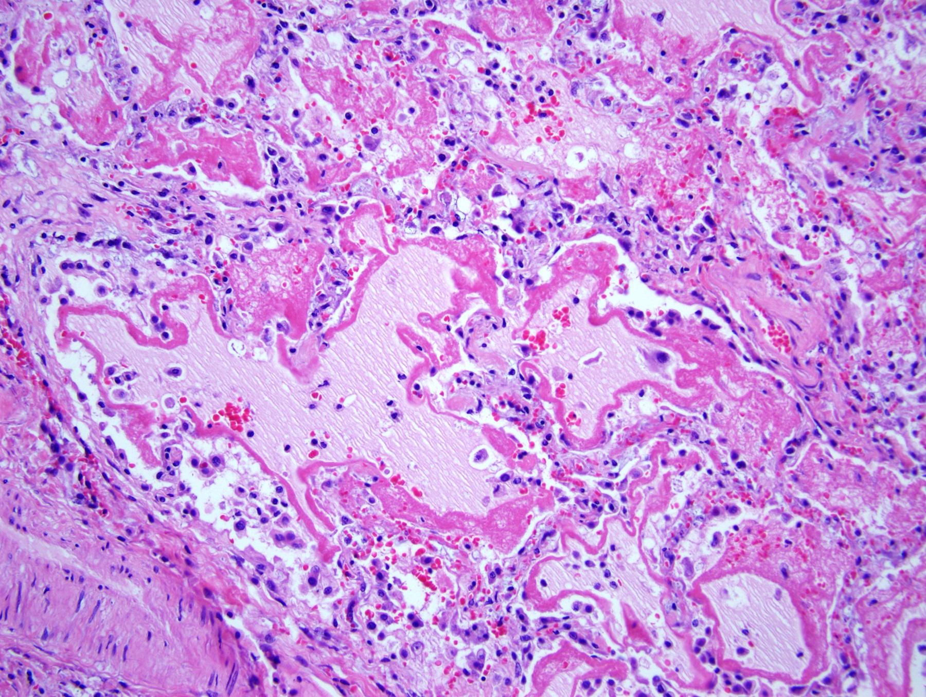 ARDS-Histology